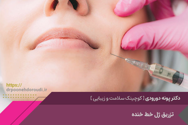 تزریق ژل خط خنده در اصفهان