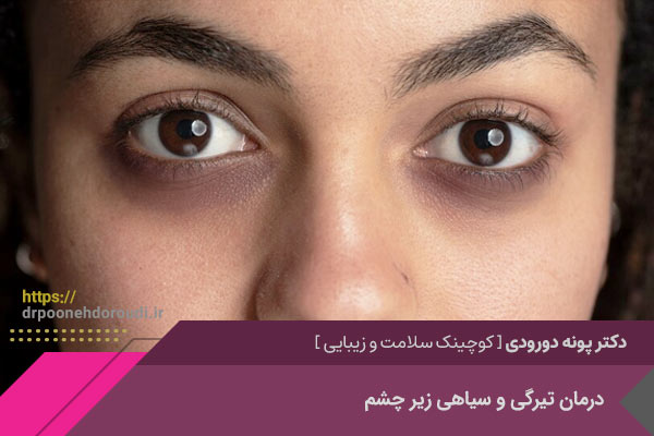 درمان تیرگی زیر چشم در اصفهان
