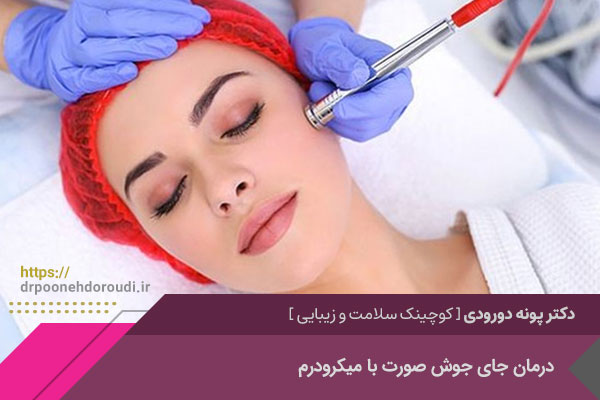 درمان جای جوش صورت با میکرودرم در اصفهان