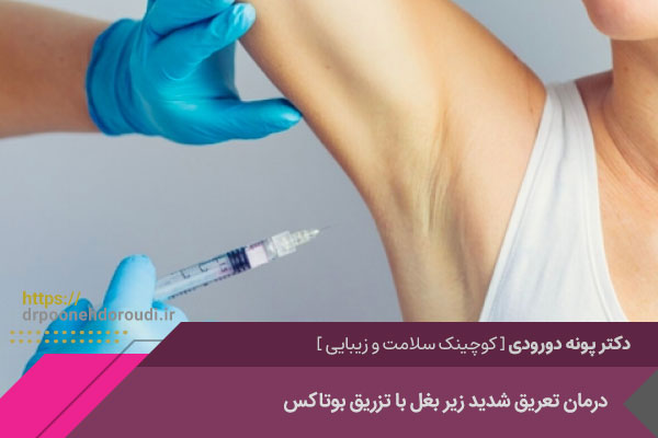 درمان تعریق شدید زیر بغل با تزریق بوتاکس