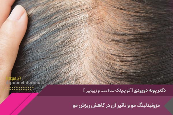 مزونیدلینگ و درمان ریزش مو 