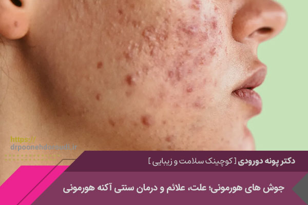 جوش های هورمونی