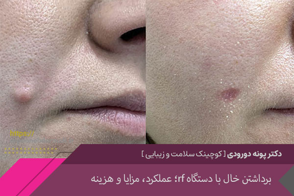 عکس برداشتن خال با دستگاه آر اف