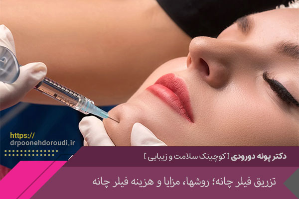 فیلر چانه