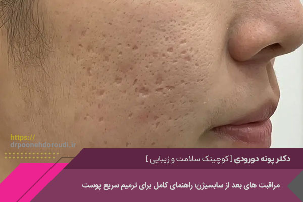 مراقبت های بعد از سابسیژن 