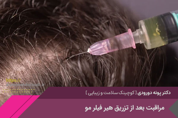 مراقبت بعد از تزریق هیر فیلر مو 