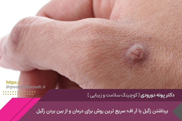 برداشتن زگیل با آر اف 