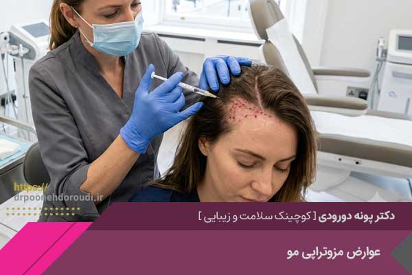 عوارض مزوتراپی مو