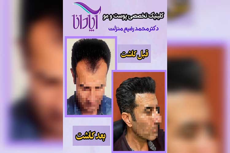 بهترین دکتر و مرکز کاشت مو شاهین شهر