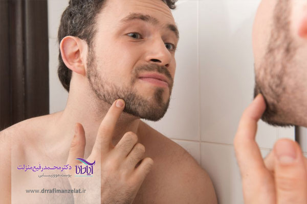 کاشت ریش و سبیل در اصفهان 
