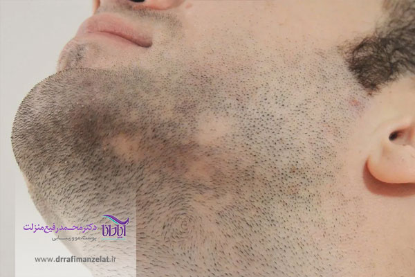 عوارض کاشت ریش و سبیل 