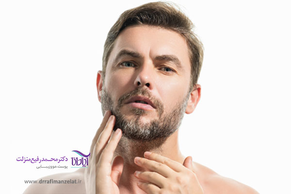 مراقبت های بعد از کاشت ریش و سبیل 