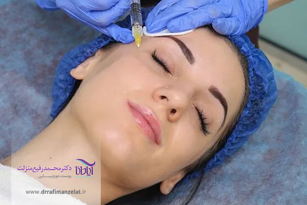 ماندگاری ژل پروفایلو چقدر است؟