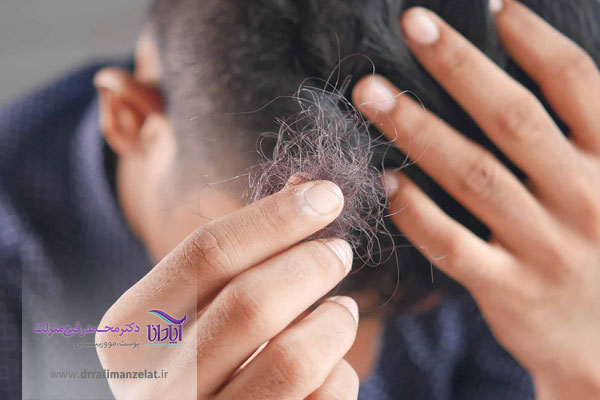 دلایل اصلی ریزش مو چیست؟