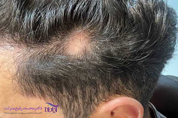عکس ریزش مو سکه ای