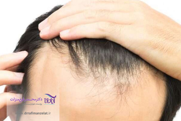 علل ریز مو در مردان 