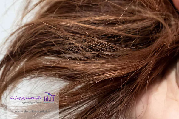موخوره گرفتن مو 