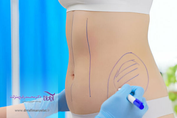 مزوتراپی لاغری