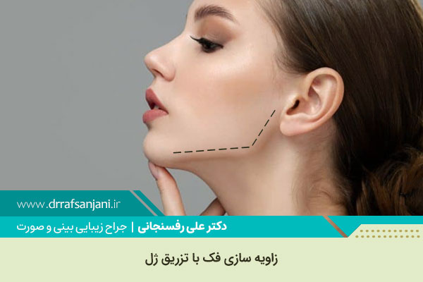 تزریق ژل زاویه فک در شهریار