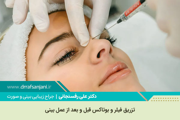 اصلاح فرم بینی با تزریق ژل و بوتاکس در کرج