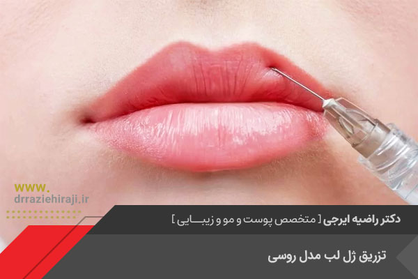 تزریق ژل لب روسی در اصفهان