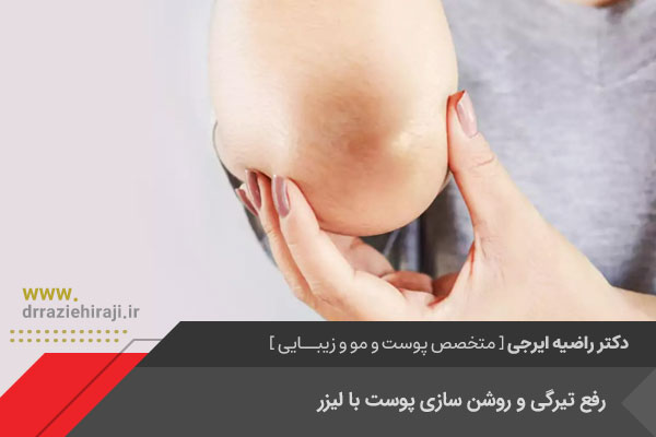 رفع تیرگی پوست با لیزر در اصفهان