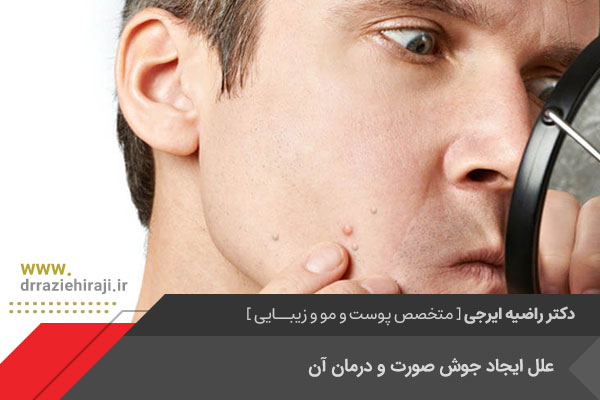 درمان جوش صورت در اصفهان