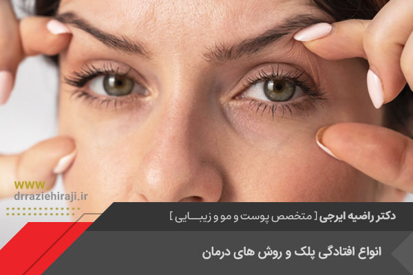 متخصص درمان افتادگی پلک در اصفهان