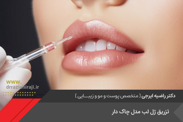 تزریق ژل لب مدل چلک دار در اصفهان