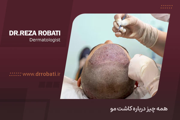 همه چیز درباره کاشت مو
