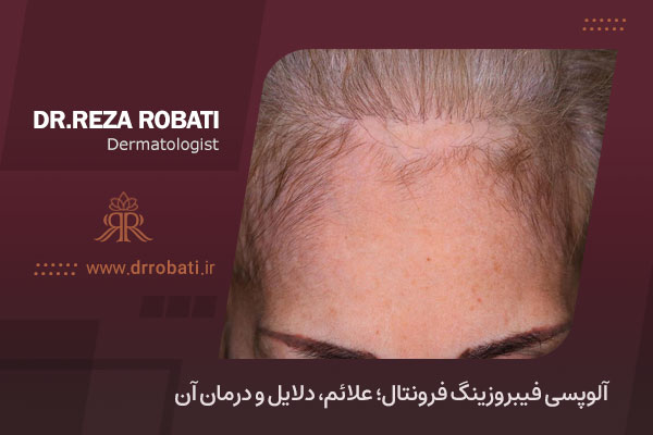 آلوپسی فیبروزینگ فرونتال چیست؟