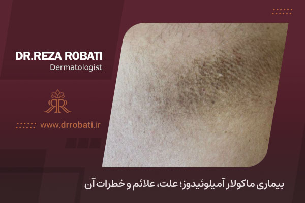 بیماری ماکولار آمیلوئیدوز