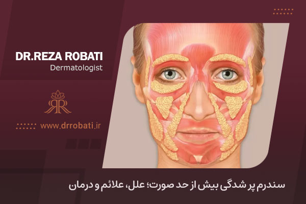 سندروم پر شدگی صورت