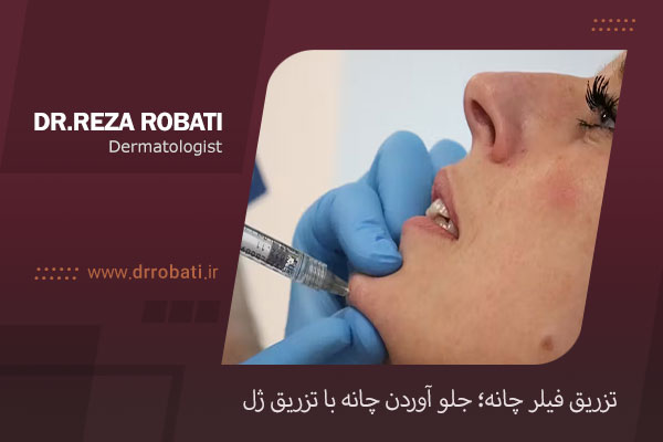 عکس فیلر چانه