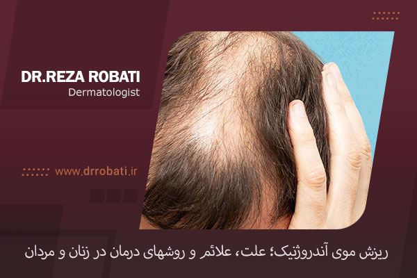 ریزش مو آندروژنیک
