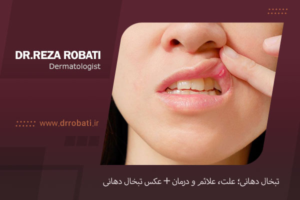عکس تبخال دهانی