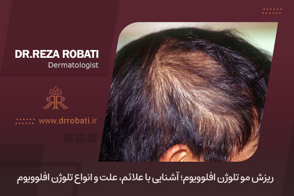 ریزش مو تلوژن افلوویوم چیست