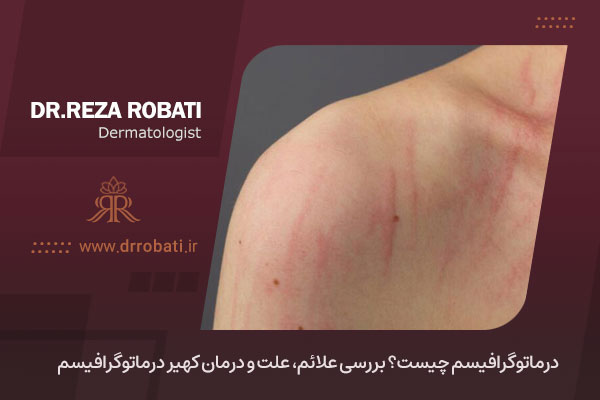 درماتوگرافیسم چیست