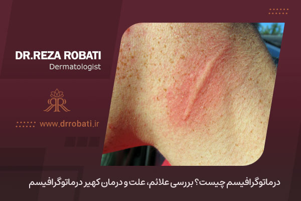 درماتوگرافیسم