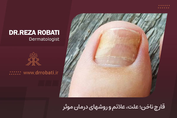 قارچ ناخن چیست؟