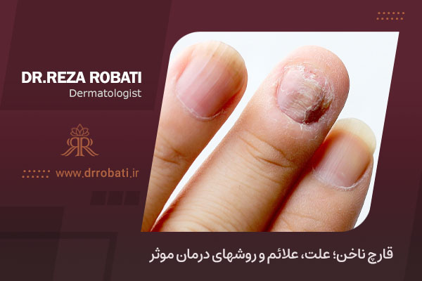 درمان سریع قارچ ناخن