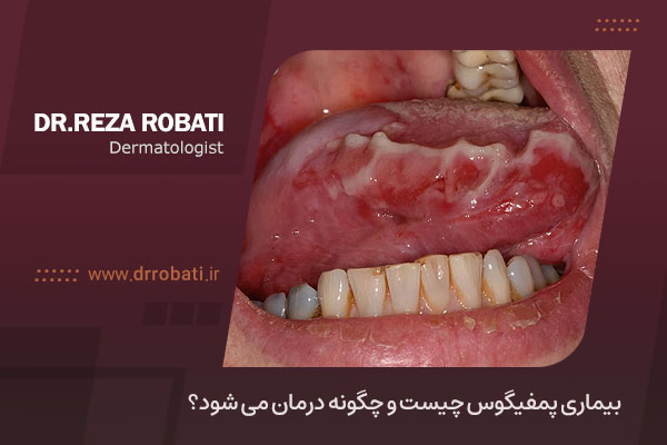 عکس بیماری پمفیگوس