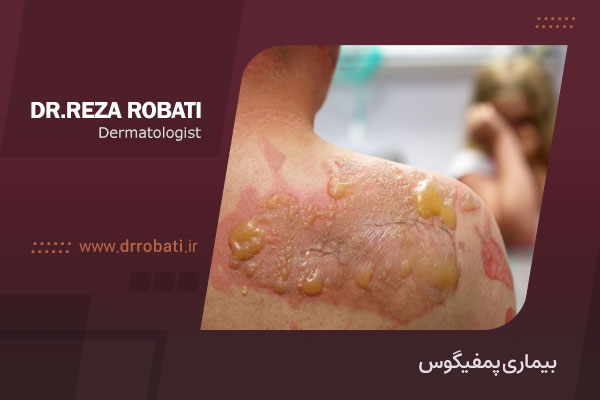 بیماری پمفیگوس
