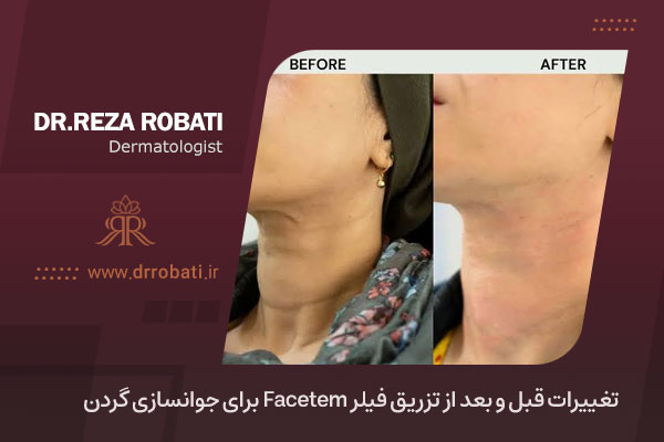 ژل Facetem