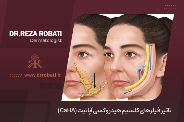 فیلر (CaHA)