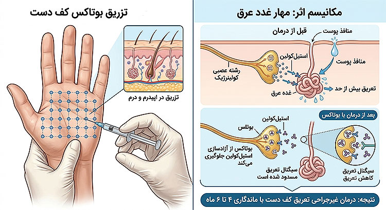  بوتاکس کف دست برای عرق