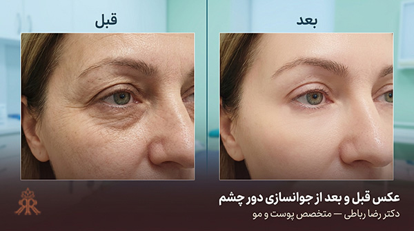 عکس قبل و بعد از جوانسازی دور چشم