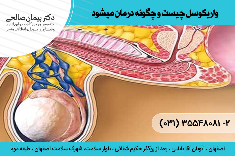 بهترین درمان واریکوسل در اصفهان