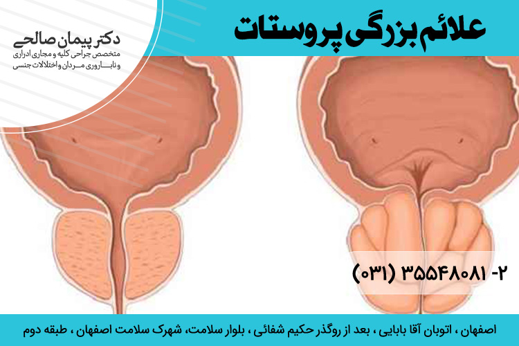 بهترین درمان بزرگی پروستات در اصفهان