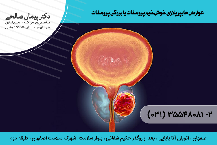 درمان بزرگی پروستات د اصفهان